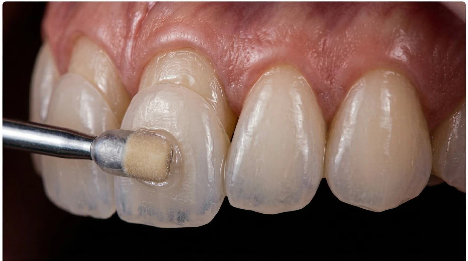 Porcelain veneer translucency – ArtSmiles Gold Coast