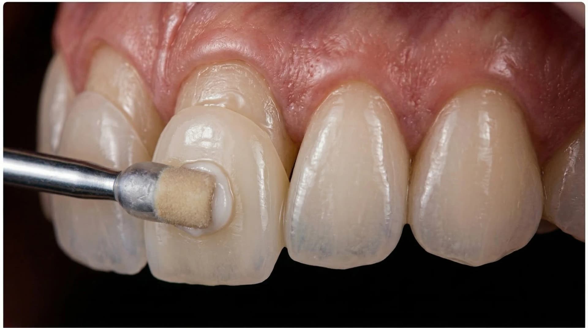 Zirconia veneer opacity – ArtSmiles Gold Coast